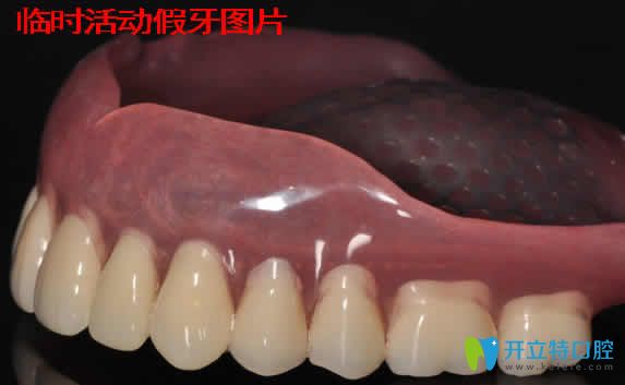 臨時(shí)活動(dòng)假牙能戴多久？資深牙醫(yī)分享戴臨時(shí)假牙注意事項(xiàng)