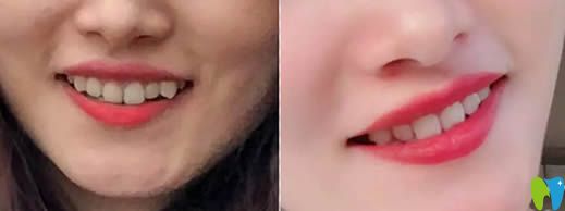 廈門(mén)<!--<i data=20240703-sp></i>-->口腔隱適美虎牙矯正案例效果