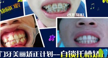 廣州康圓口腔謝姍婷自鎖托槽牙齒正畸效果圖