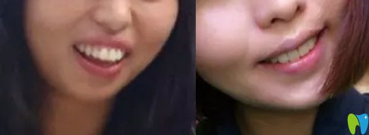 齙牙矯正前后效果對(duì)比圖