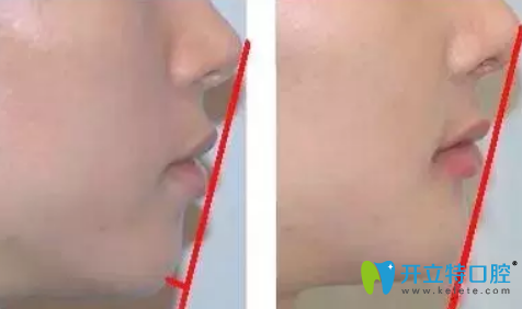 簡(jiǎn)單的判斷齙牙是牙性還是骨性的方法