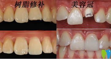 開(kāi)立特口腔解答斷牙如何修復(fù)