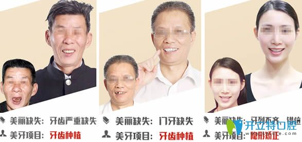 全口種植牙及門牙缺失種植案例效果圖