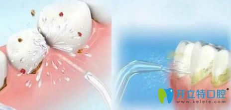開(kāi)立特口腔解答噴砂潔牙和超聲波潔牙的區(qū)別在哪
