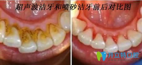 開(kāi)立特口腔解答潔牙后注意事項(xiàng)