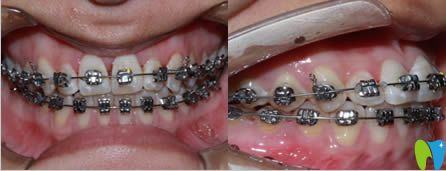 廈門亞歐齒科姚森院長牙齒正畸案例