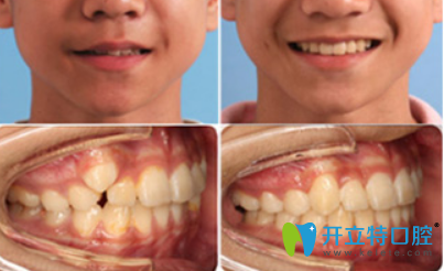深圳河山齒科怎么樣？吳菊珍13歲少年虎牙矯正案例效果來證明
