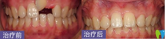 深圳烤瓷牙哪家好？鵬程口腔牙齒修復(fù)案例來嘍
