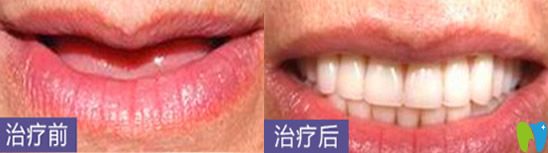 深圳哪家種植牙好？看深圳鵬程口腔種植牙案例