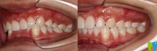 深圳河山齒科吳偉斌靠譜嗎？來(lái)看吳偉斌正畸案例