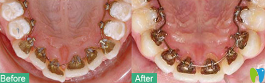 深圳牙齒正畸哪家好？鵬程口腔真人案例來驗(yàn)證