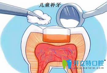開立特口腔網(wǎng)解答兒童補(bǔ)牙有必要嗎