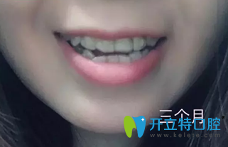 牙齒過(guò)度擁擠在深圳鵬程口腔戴隱形牙套3個(gè)月時(shí)候照片