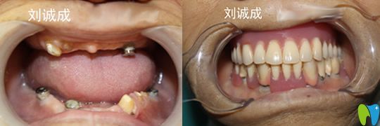 劉誠(chéng)成種植+套筒冠修復(fù)案例