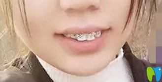 牙齒矯正3個(gè)月照片 牙齒矯正3個(gè)月照片