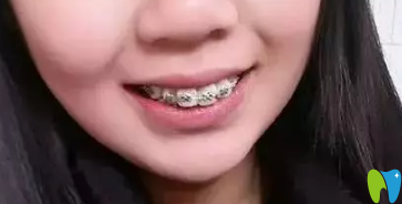 在拉斐爾口腔做牙齒矯正第6個(gè)月 在拉斐爾口腔做牙齒矯正第6個(gè)月