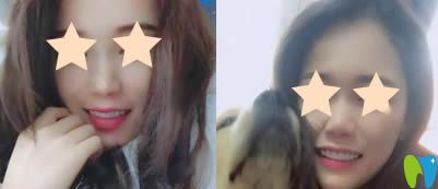 重慶眾植博仕口腔超薄牙貼面術后一月照 重慶眾植博仕口腔超薄牙貼面術后一月照