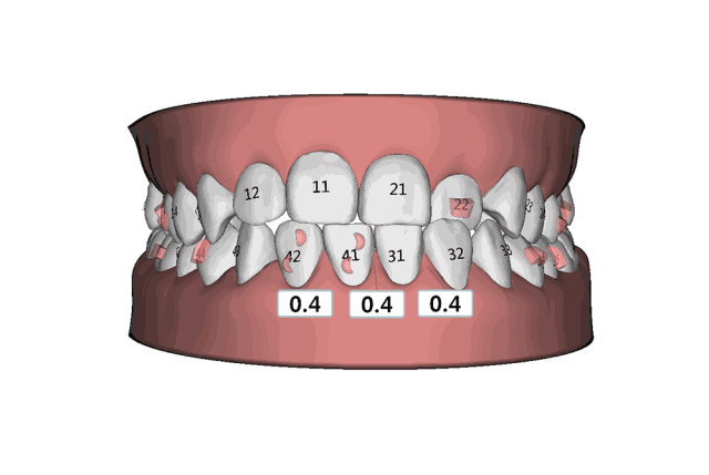 矯正牙齒的目的