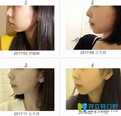 我在福州格萊美做牙齒矯正1-11個(gè)月左臉變化過程圖 我在福州格萊美做牙齒矯正1-11個(gè)月左臉變化過程圖