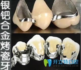 銀鈀合金烤瓷牙好不好