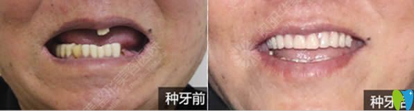 半口牙缺失種植案例及對比照