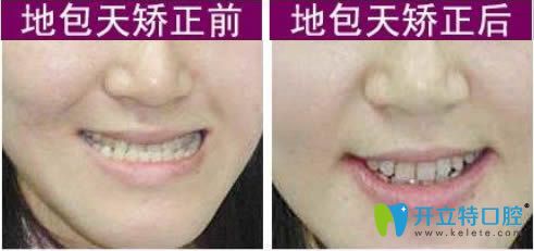 貴陽華美口腔李森醫(yī)生地包天矯正案例及前后對比照