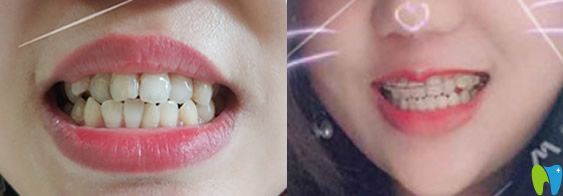 在北京溪美康口腔做牙齒矯正后對比