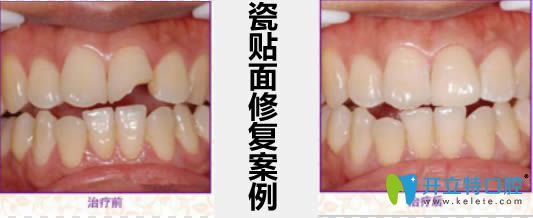 瓷貼面修復案例及前后對比效果