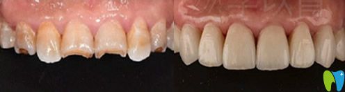 李以霄牙齒修復真人案例 李以霄牙齒修復真人案例