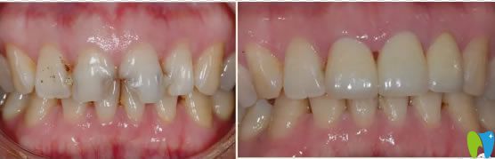 齲齒修復案例及對比效果 齲齒修復案例及對比效果