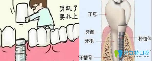 牙齒缺失為什么要做種植牙