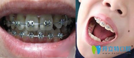 牙齒正畸可以只做局部嗎