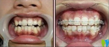 牙齒擁擠不齊矯正案例對比圖