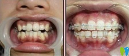 <!--<i data=20240703-sp></i>-->李智醫(yī)生成人半隱形牙齒矯正案例 <!--<i data=20240703-sp></i>-->李智醫(yī)生成人半隱形牙齒矯正案例