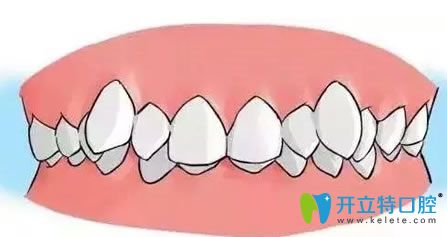 牙齒矯正常見問題 牙齒矯正常見問題