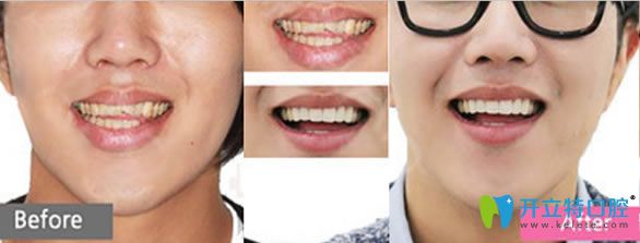 雷桂芳醫(yī)生前門牙修復(fù)前后對比案例 雷桂芳醫(yī)生前門牙修復(fù)前后對比案例