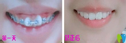 牙齒只有一兩顆不齊可以做半口矯正嗎？來(lái)看北京中諾口腔半口牙矯正真人案例