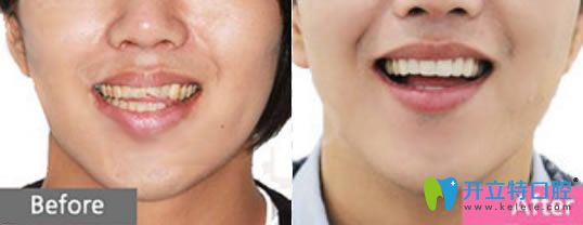 <!--<i data=20240703-sp></i>-->高安分醫(yī)生瓷貼面修復(fù)案例