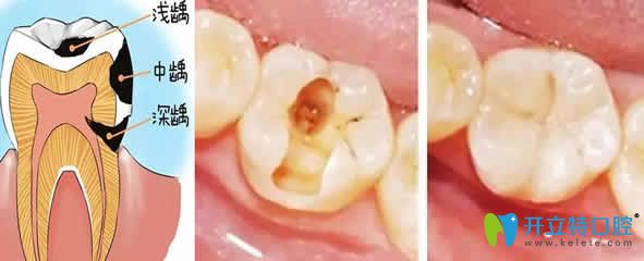 武漢優(yōu)益佳口腔張甘樂兒童齲齒治療效果圖 武漢優(yōu)益佳口腔張甘樂兒童齲齒治療效果圖