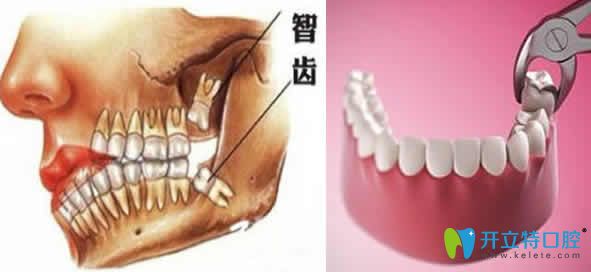 智齒拔后疼多久算正常