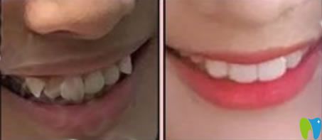 成人虎牙矯正案例對比照