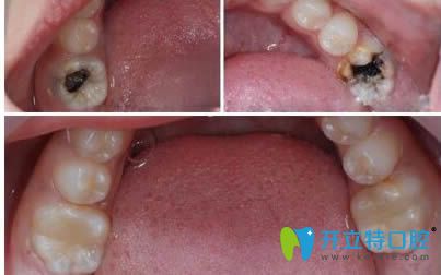 威海舒好口腔李慧齲齒修復(fù)效果對比圖