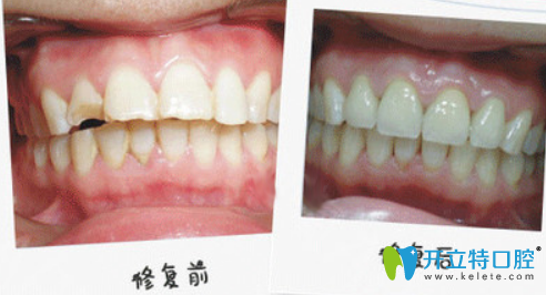 重慶齊美口腔王婷怎么樣？王婷牙齒修復(fù)真人案例效果來驗(yàn)證
