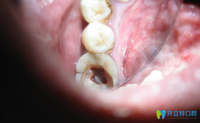 后悔給孩子做根管治療，體驗(yàn)后揭露醫(yī)生不會(huì)說(shuō)的根管秘密