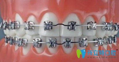 傳統(tǒng)金屬托槽