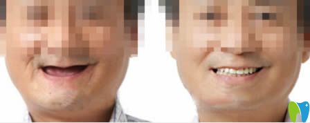 長(zhǎng)春超龍牙博士口腔蔣唯全口種植牙案例