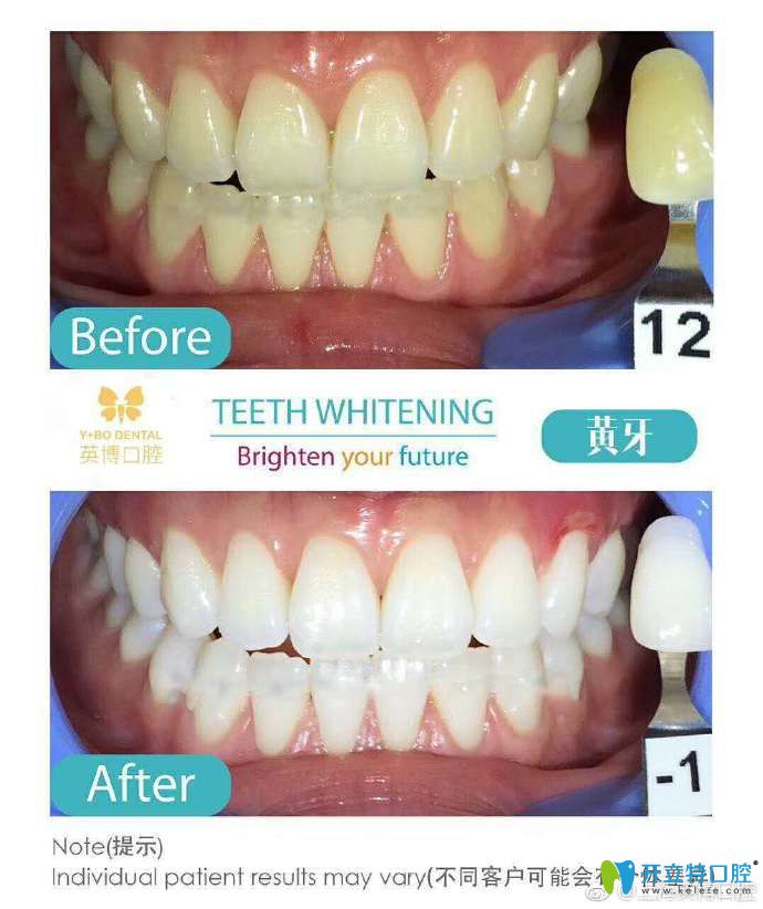 <!--<i data=20240703-sp></i>-->英博口腔韓主恩牙齒美白案例前后治療效果對(duì)比圖