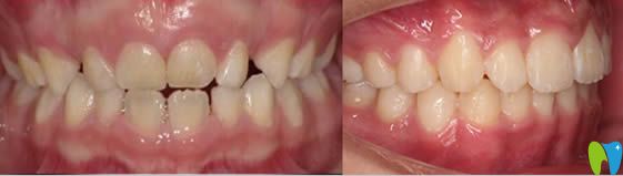 <!--<i data=20240703-sp></i>-->恒愿口腔兒童牙齒正畸完成照