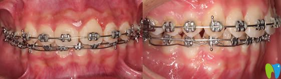 <!--<i data=20240703-sp></i>-->恒愿齒科牙齒矯正術中照