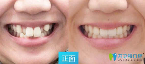 28歲顧客隱適美隱形矯正前對(duì)比效果